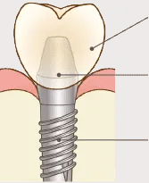 インプラントの構造