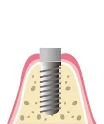 インプラント埋込時