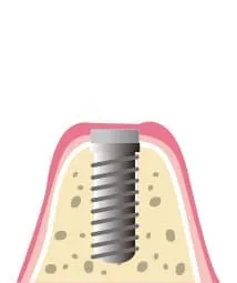 インプラント体埋入