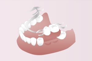 義歯・入れ歯～平均寿命 4～5年以上～