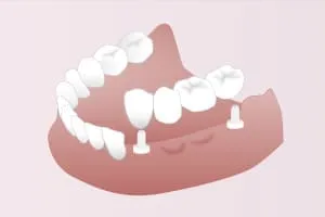 ブリッジ~平均寿命 7~8年以上~