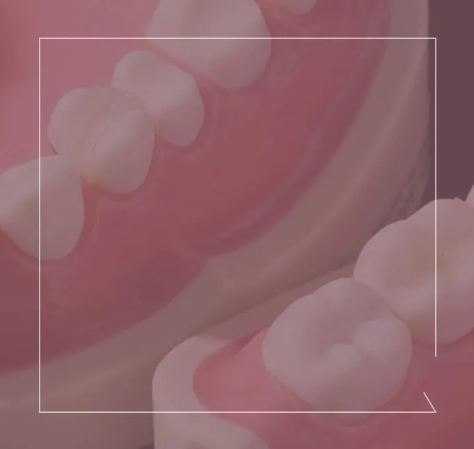 メタルフリーセラミック