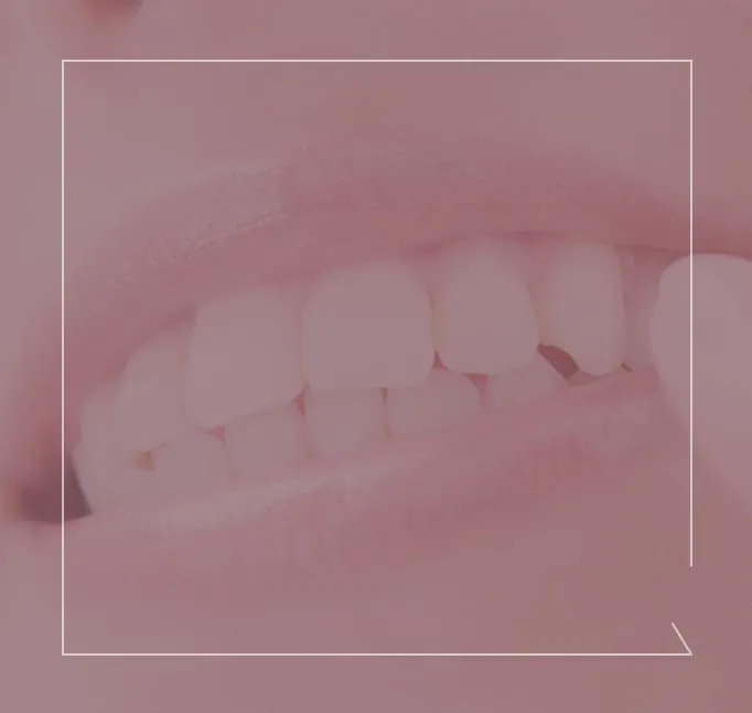 ホワイトニング