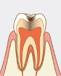 冷たい水や風が歯にしみる
