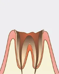 歯が溶けて根本部分だけ残った状態