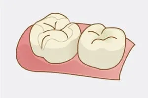 セラミックインレー