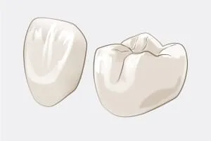 セラミッククラウン