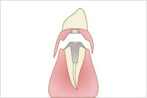 インプラントオーバーデンチャー