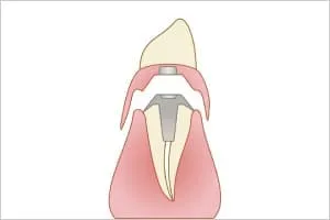 インプラントオーバーデンチャー